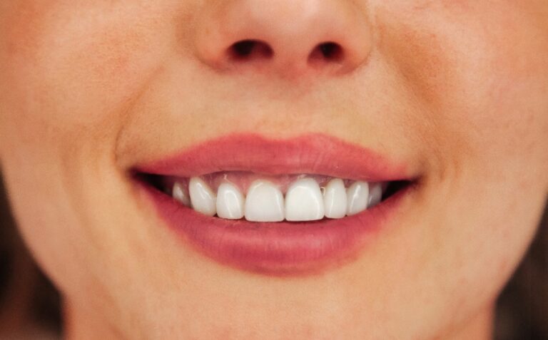 Comparatif avant et après blanchiment des dents, montrant un sourire nettement éclairci