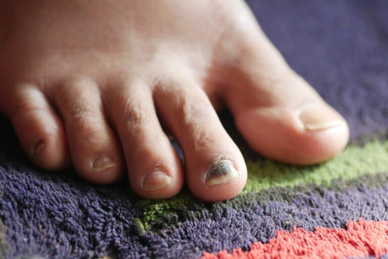 Ongle de pieds qui est devenu noir